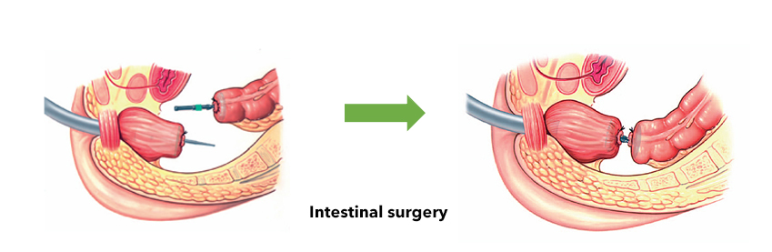 circular-stapler-Indication.jpg circular-stapler-Indication.jpg
